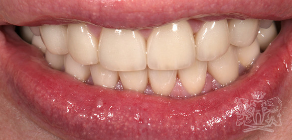 Результат после: Стираемость зубов