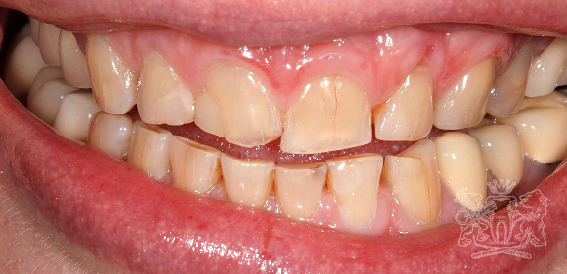 Результат до: Стираемость зубов