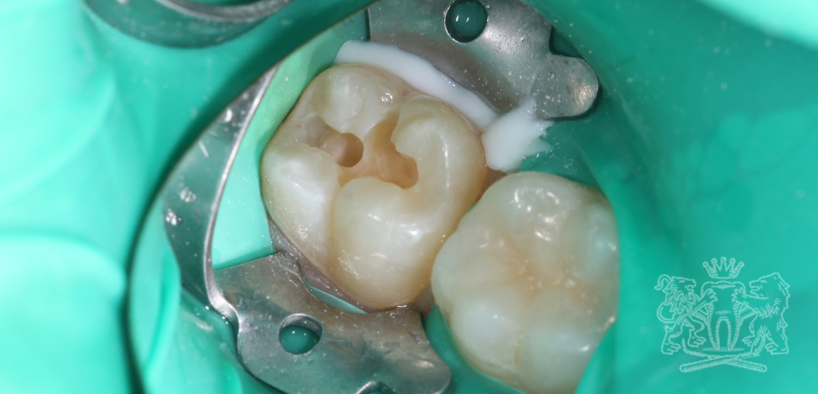 Результат до: Реставрация жевательного зуба