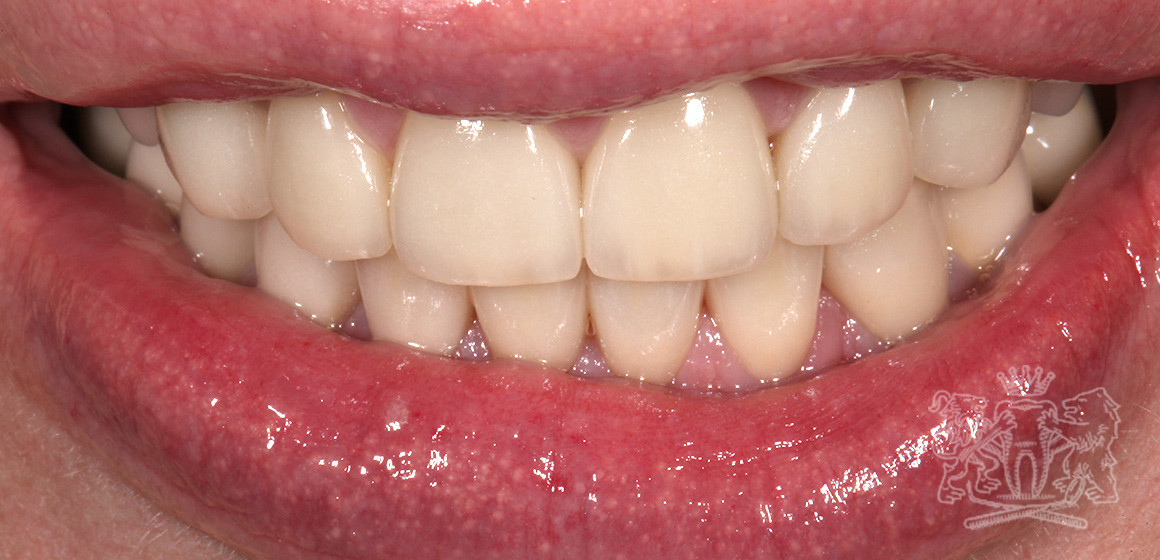 Результат после: Стираемость зубов
