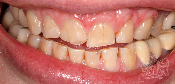 Результат до: Стираемость зубов